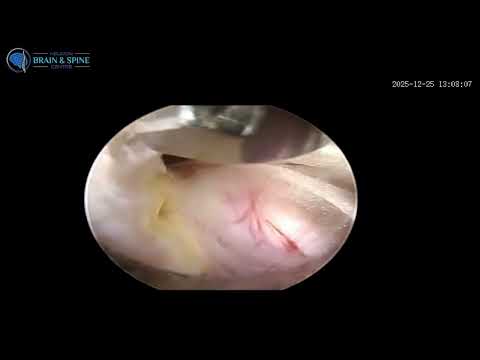 He Had to Quit Playing Football Due to Pain… Until Dr. Achal Treated Him