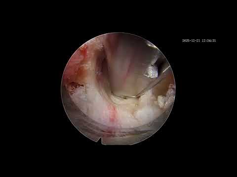 From Years of Constant Back Pain to Relief | Sciatica Treated by Dr. Achal